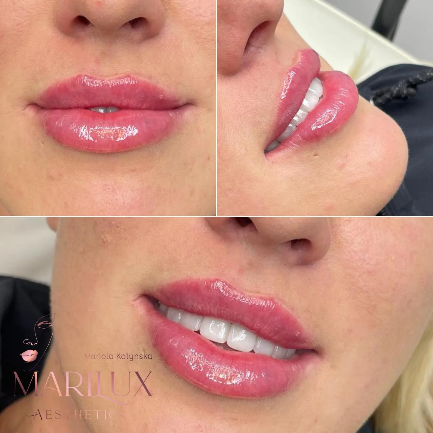 Lip filler result 6 — premium aesthetic results